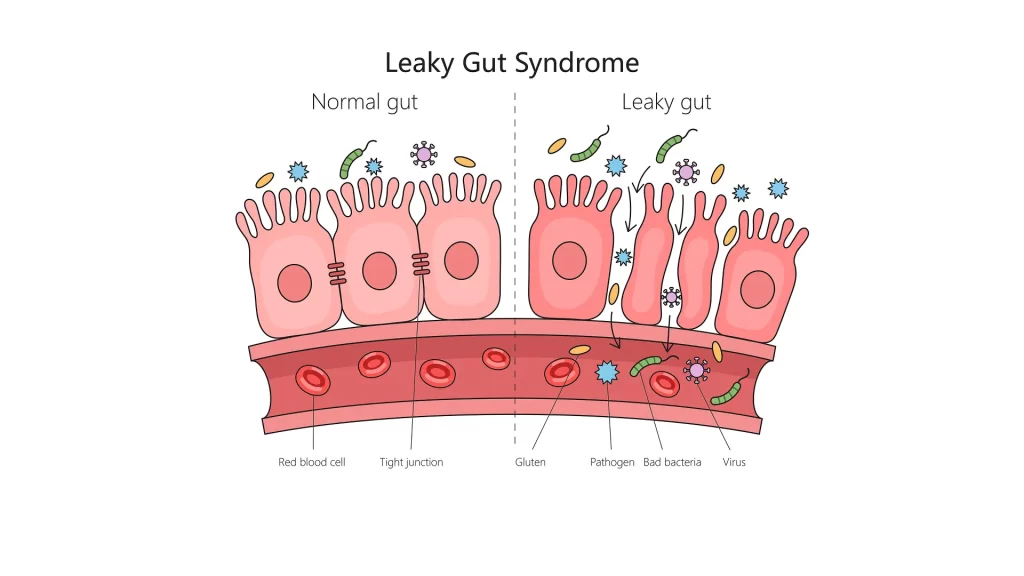 Side-by-side illustration of a healthy gut lining with intact tight junctions and a damaged gut lining showing gaps between cells. Gluten particles are shown around the damaged lining to highlight how gluten and glyphosate contribute to leaky gut and autoimmune responses.